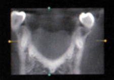 3次元歯科用CTの特徴1