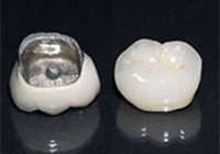メタルボンド・臼歯